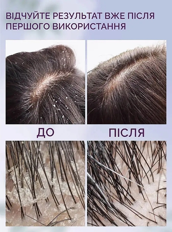 Пилинг для жирной кожи головы с AHA и BHA кислотами - Reclaire Scalp Peel — фото N7