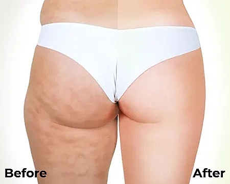 Курс антицеллюлитных обертываний с маслом ксимении - Hillary Anti-cellulite Bandage African Ximeniaa — фото N8